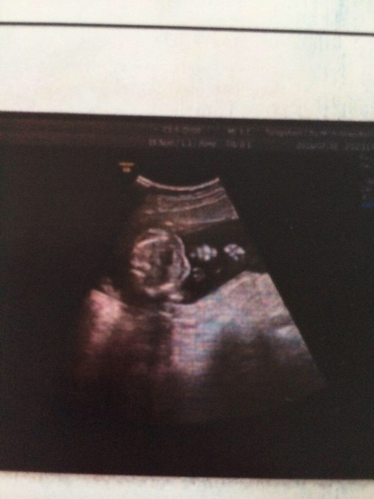 怀孕18周真实胎儿图片,怀孕18周胎儿和什么一样大