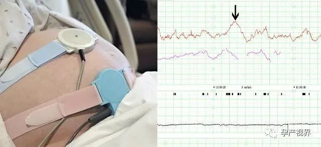 刚怀孕50天做b超能检查出来什么,怀孕初期检查hcg翻倍需要查几次