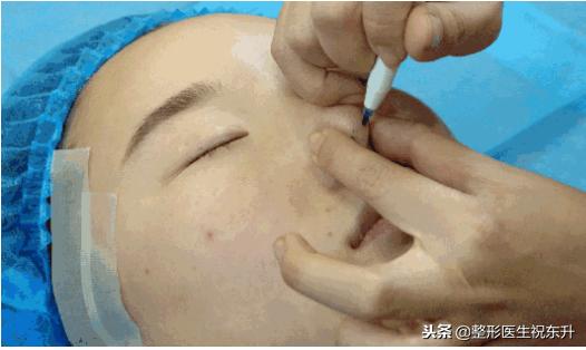 红色预警发出后规定的防范措施,哪些鼻型不适合线雕隆鼻