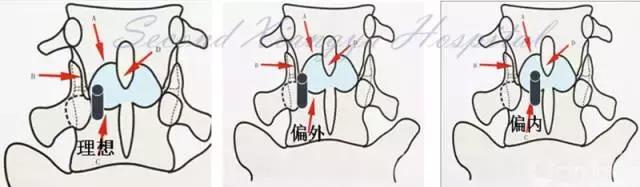 经皮腰椎间盘切除术有何优缺点,什么是经皮内镜腰椎手术