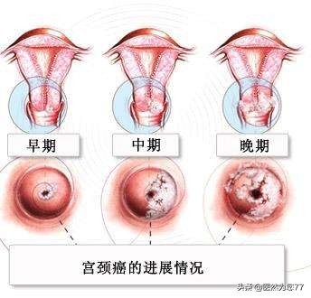 女性做宫颈癌筛查需要多少钱,65后需要做宫颈癌筛查吗