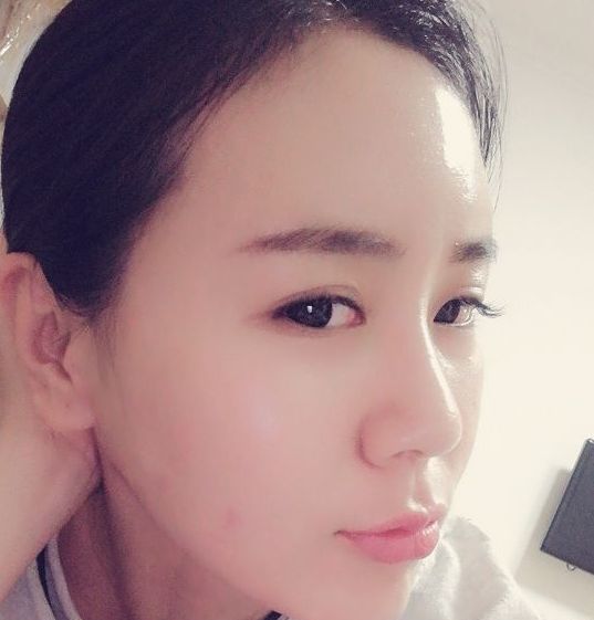 额头扁平怎么填充自然好看,额头颞部怎么填充好看