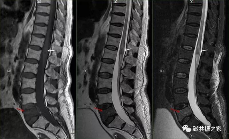 腰椎有哪些病变,腰椎病变有几种