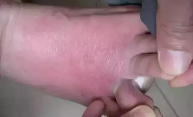 脚气痒得厉害怎么快速止痒偏方,脚气怎么根治三个简单的小方法