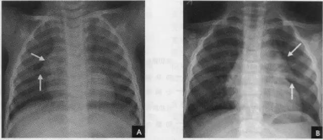 x线影像解剖大全,胸部x线怎么看懂图解