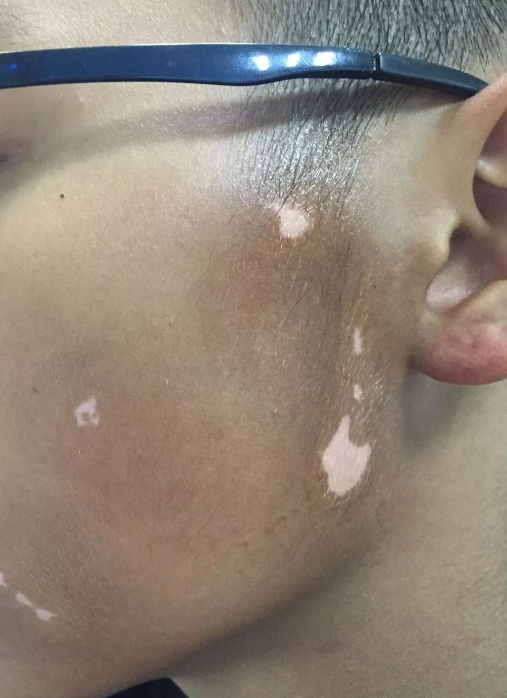 儿童治疗白癜风需要多少钱,uvb治疗白癜风多久见效