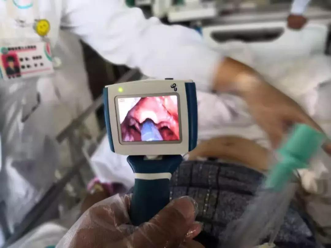 胃管导丝拔不出来什么原因,胃管拔不出来怎么回事