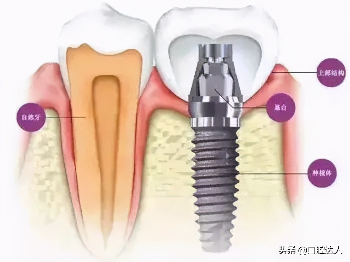 种植牙取模的标准流程,种植牙三期戴牙冠流程