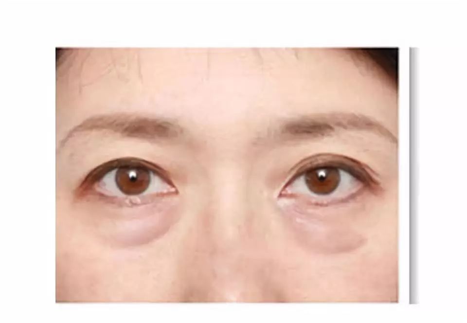 40岁消除眼皮浮肿和眼袋,眼袋怎么消除改善大眼袋