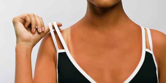 晒后晒伤发红修复最有效的办法,晒后修护可以涂抹晒伤的皮肤吗