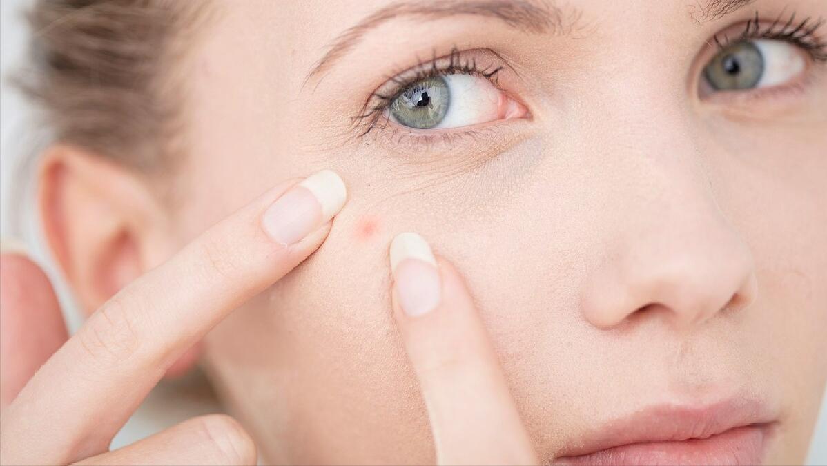 脸上长脓包痘痘快速去掉,脸上长痘痘该怎么调理除湿