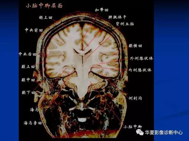 mra头颅解剖学详细讲解视频,常见的头颅mri图像