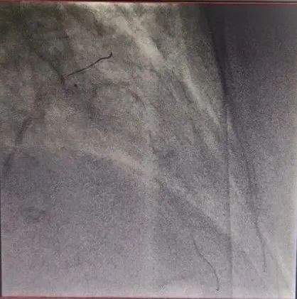 北京积水潭医院心内科成功开展医疗新技术！准分子激光冠脉消蚀术与冠脉旋磨术治疗冠脉钙化病变
