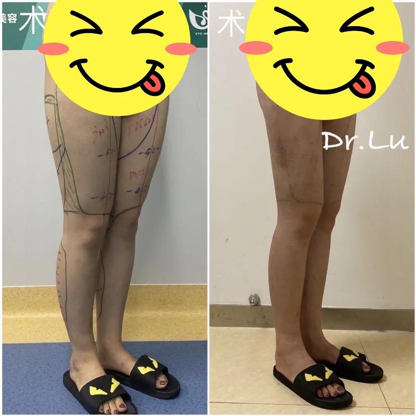 吸脂和溶脂针选哪个,怎么看是需要打瘦腿针还是吸脂