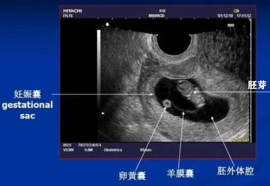 胚胎九周发育正常突然胎停原因,孕9周胎停育前兆