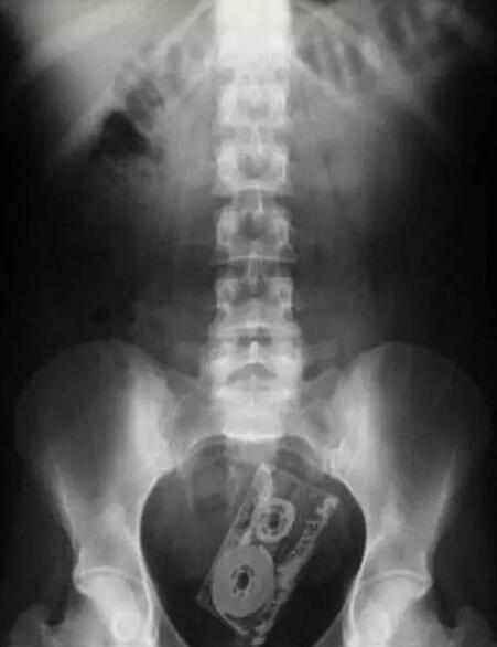 不作死就不会死,看看这些被人类搞进身体里的异物