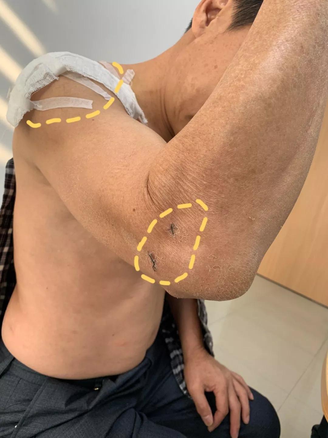 肩袖损伤肘关节旋转康复训练,肩关节损伤治疗微创视频