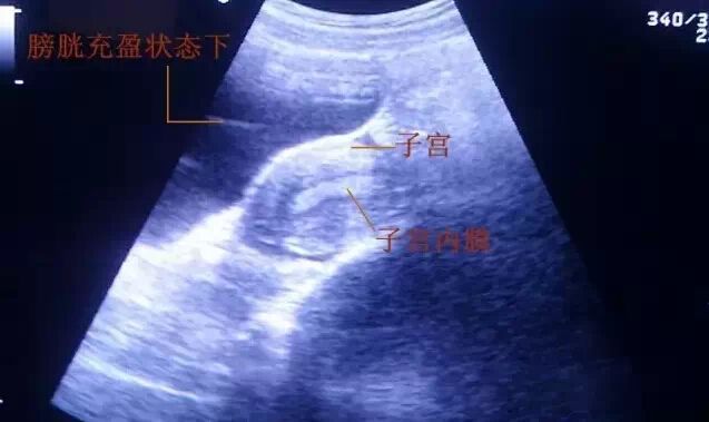 移植时憋尿肚子疼会影响胚胎吗,胚胎移植前憋尿的正确方法