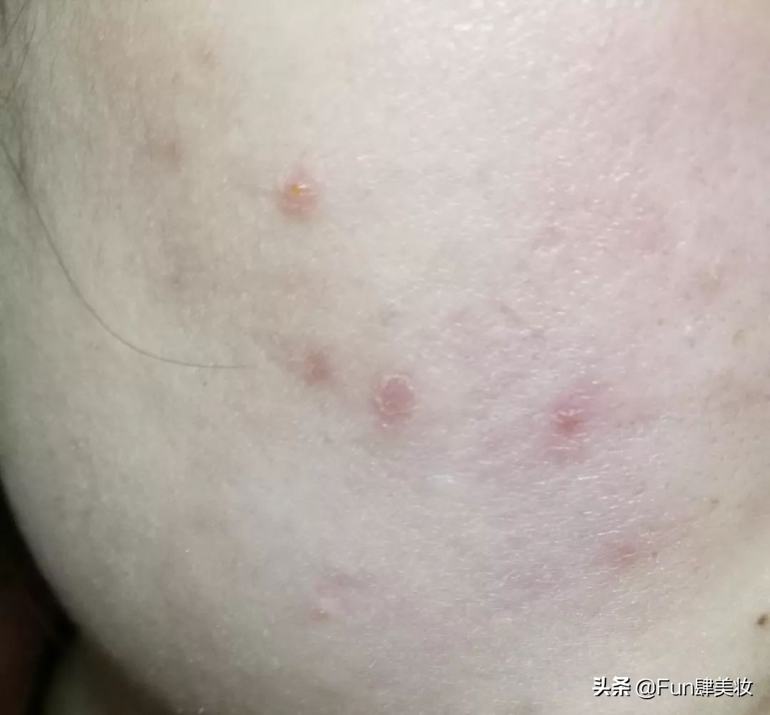 痘印痘坑真正祛除的方法,痘印痘坑去不掉怎么办