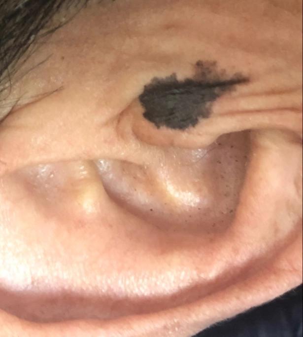 黑痣到底是什么样子,身上最可怕的黑痣