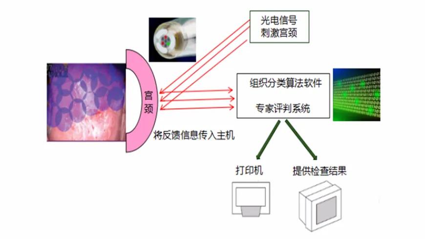 宫颈癌筛查指南最新进展,宫颈癌筛查怎样才算好的结果