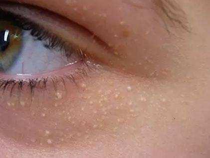夏天出汗眼睛周围起疙瘩怎么回事,脸上眼睛周围有小米粒那样的疙瘩