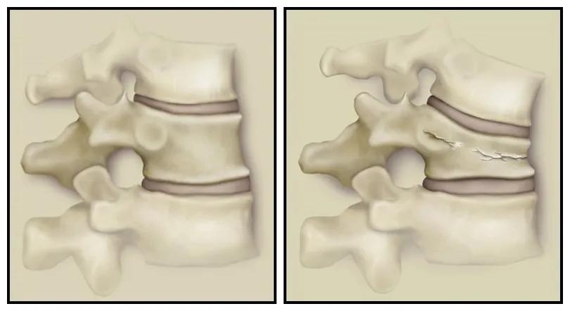 老人腰部骨折症状,老人怎样判断腰疼是否是骨折