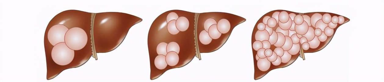 肝囊肿什么情况下要做手术呢,什么样的肝囊肿会自愈