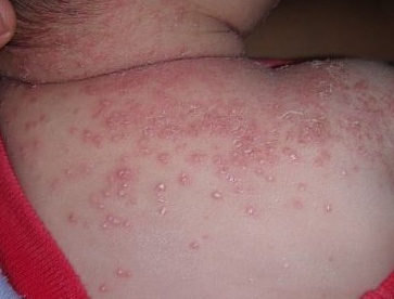 宝宝湿疹妈妈需要干预吗,宝宝湿疹反复怎么从根本解决