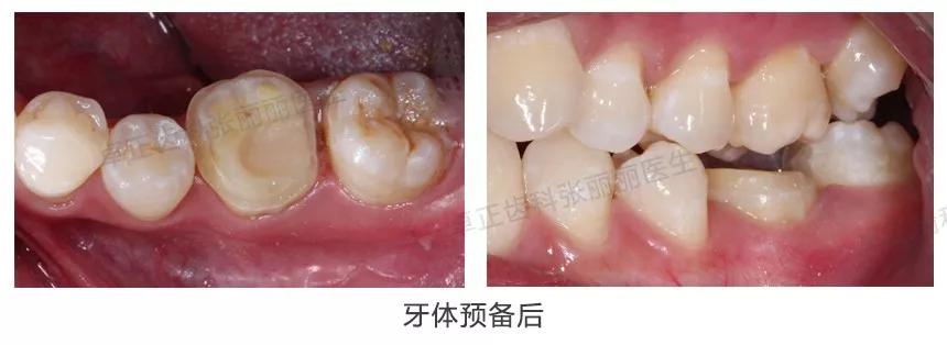 牙齿楔状缺损修复视频,牙齿缺损了可以选择哪些修复方式