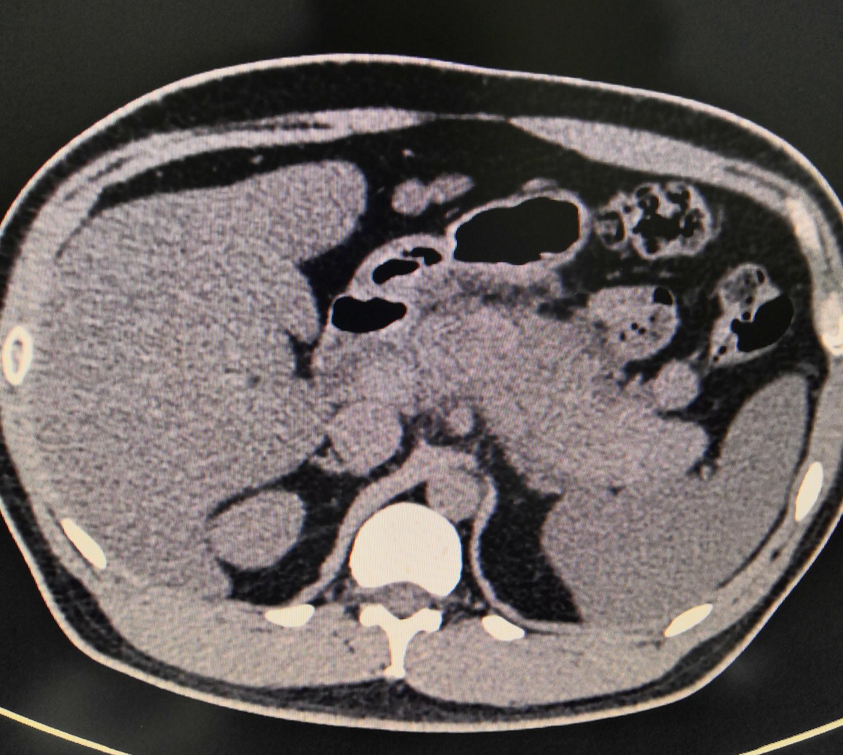 腰背疼是胰腺病的前兆,腰背刺痛胰腺炎