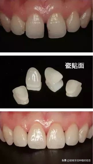 中年牙缝越来越大是什么原因,牙齿越来越稀疏牙缝大怎么办