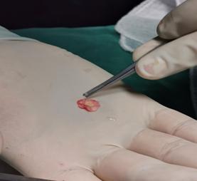 一不小心耳膜破了，怎么办？