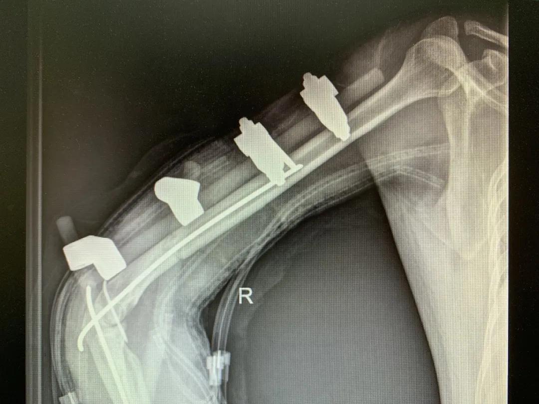 【日照市人民医院】右臂卷入机器被撕裂　6.5小时成功复活