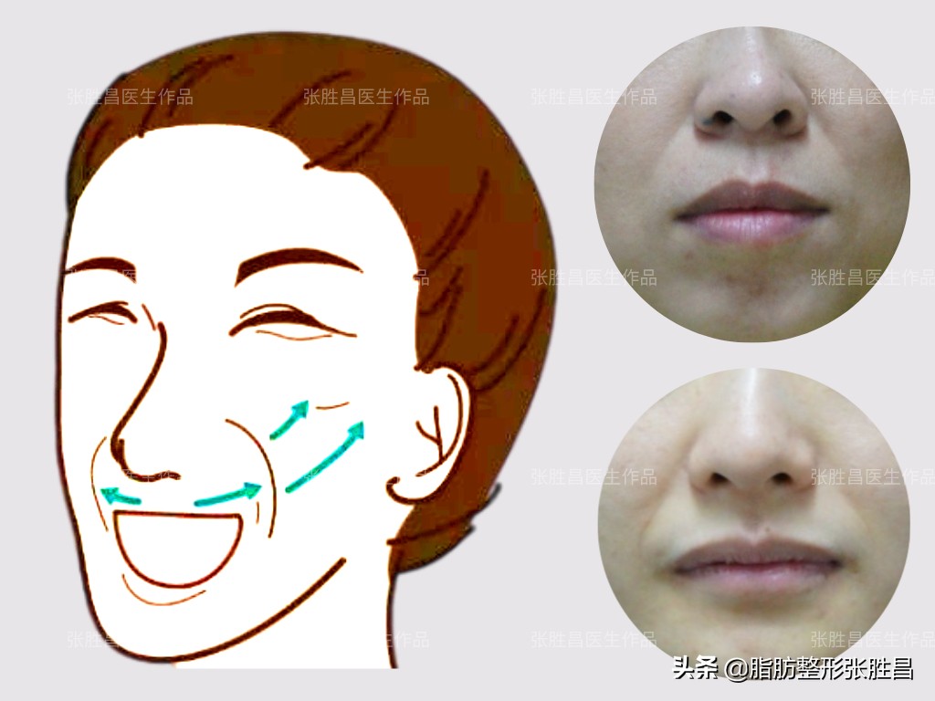 爱笑的女孩笑起来法令纹很明显,笑的时候有法令纹的人怎么样