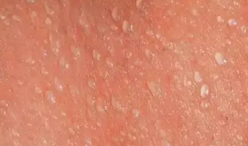 宝宝夏天起痱子需要抹药吗,婴儿夏天起痱子最有效的解决方法