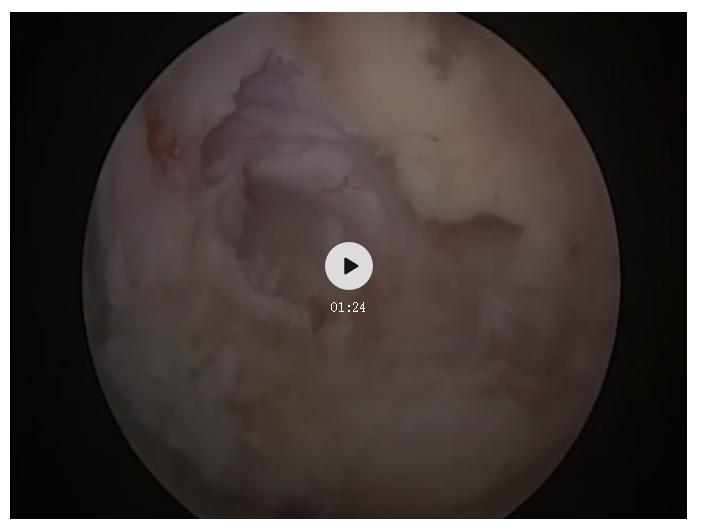 脊椎压迫神经做了微创术后腿麻疼,神经根损伤疼痛治疗