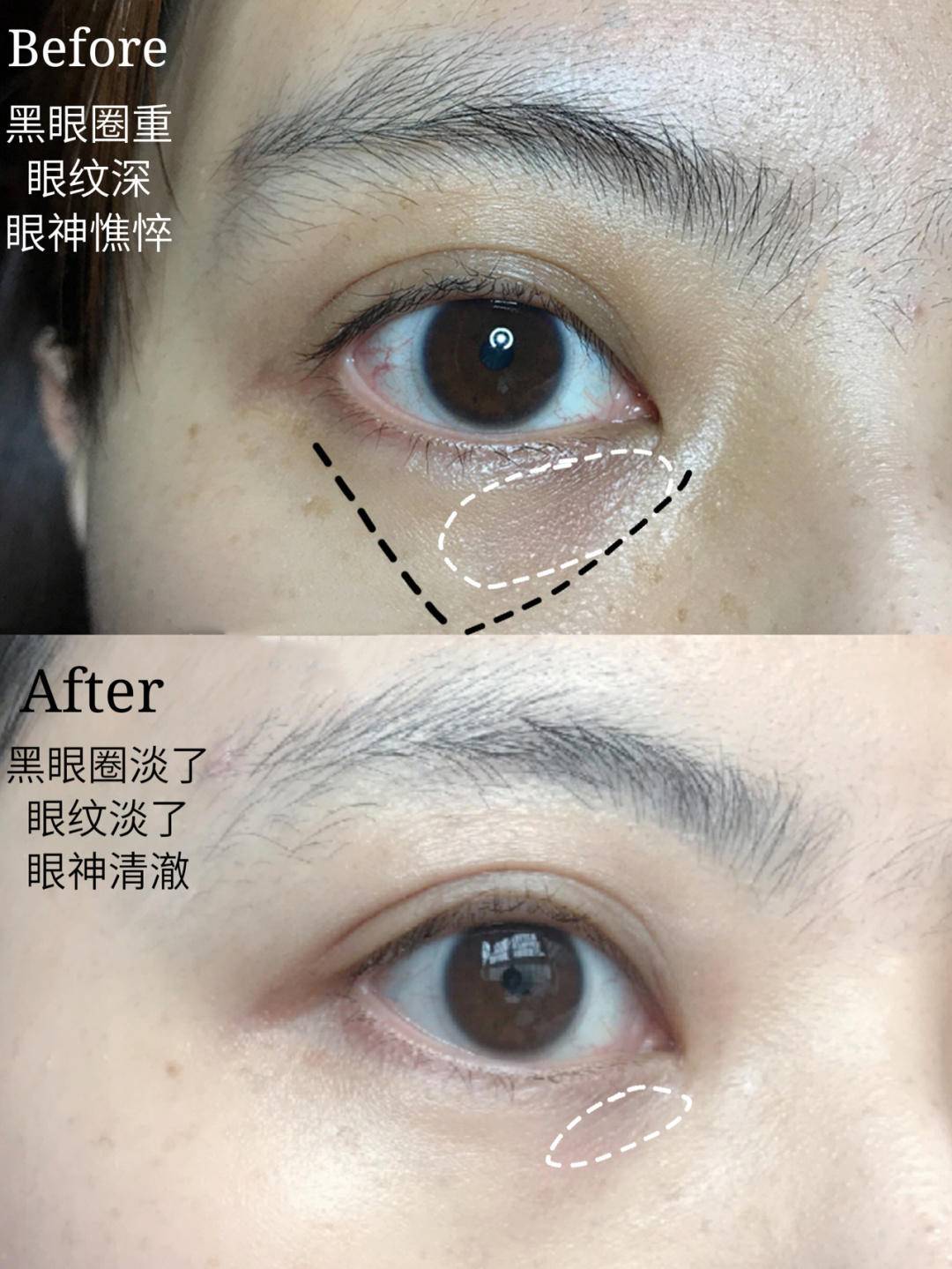 眼睛没有细纹需要眼膜吗,眼膜有用吗能去皱纹吗