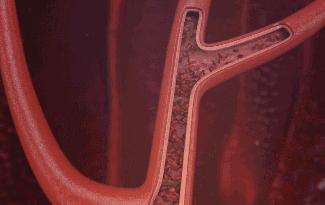 痛风合并高血压怎么预防,痛风合并其他疾病怎么治