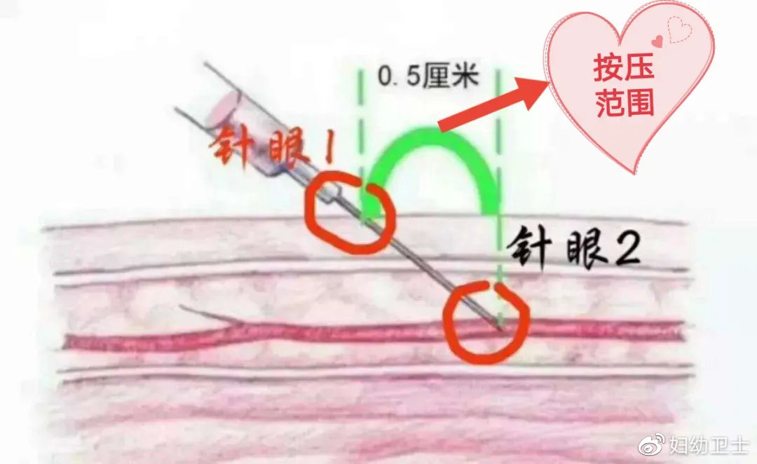 抽血拿针的正确姿势图解,抽血手握拳的正确手法