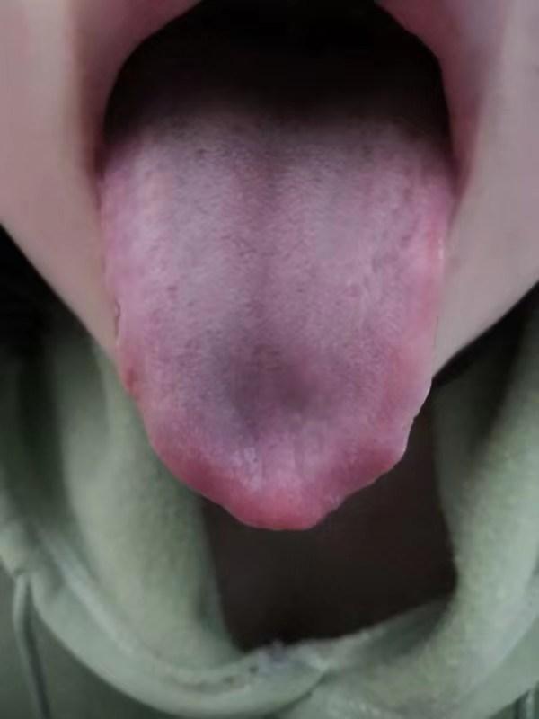 中药治疗腮腺炎、低热患者病案1例（1周）