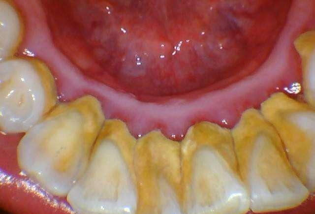 牙周炎为什么会引起牙齿松动,牙龈肿胀牙齿松动的原因牙周炎