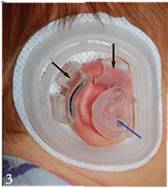 耳廓畸形高考生体检怎么办,二度耳廓畸形矫正方案