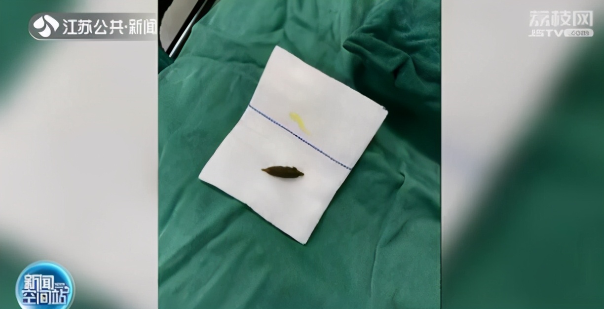 吃坚果类拉肚子,吃坚果会闹肚子吗