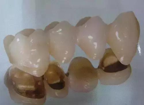 换一副烤瓷牙什么材料比较好,各类烤瓷牙材料的优缺点对比