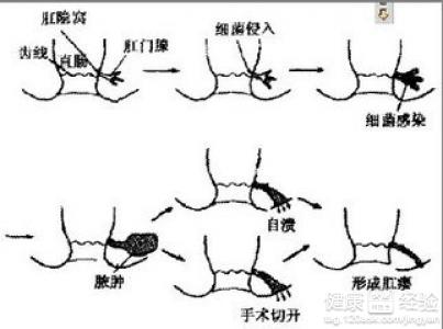 肛周脓肿中医治疗心得,肛周脓肿的治疗指南