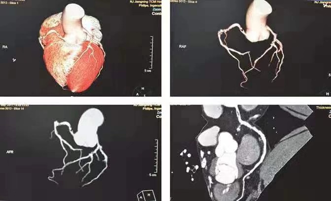 沈阳六院血栓专家,沈阳六院治疗深度静脉血栓