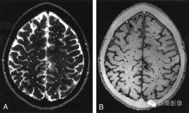 脑血管病影像诊断大全汇总,脑小血管病变影像学表现