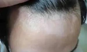 别人白斑很快恢复，自己却治疗很久也不见效果，这是怎么回事？