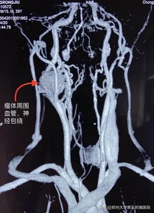 鼻咽癌导致颈部包块是早期吗,颈部包块怎么治疗最好